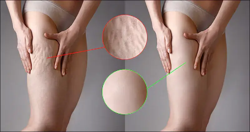 Decoding Cellulite: Causes, Treatments, and Myths Unveiled