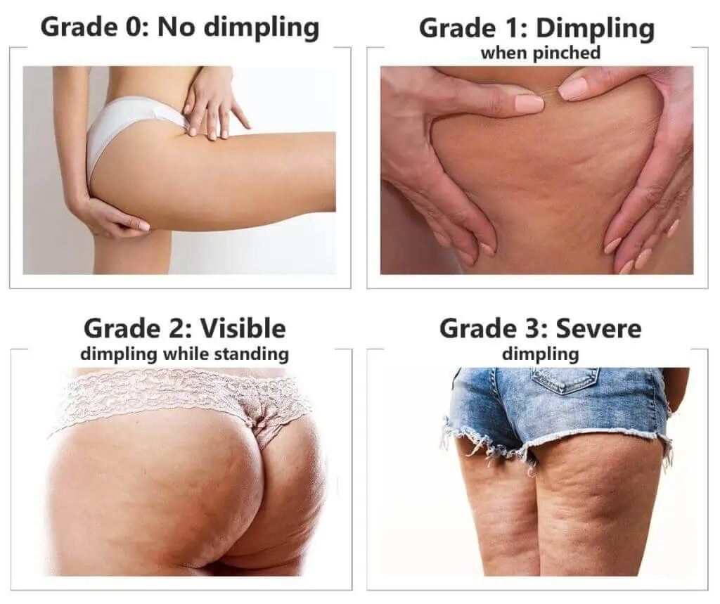 Representation of the stages of cellulite development Portsmouth