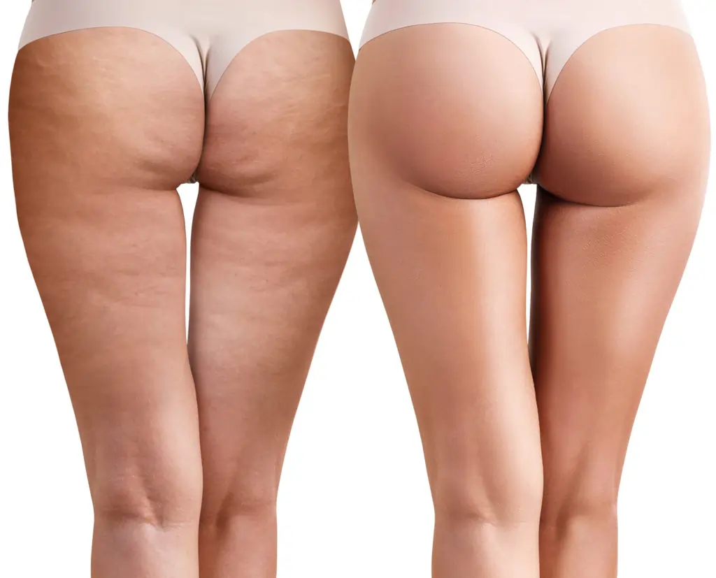 Read about cellulite Portsmouth: causes, treatments, and debunked myths